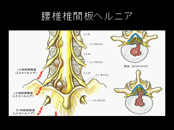 腰椎椎間板ヘルニア