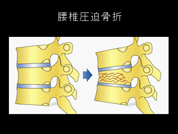 腰椎圧迫骨折