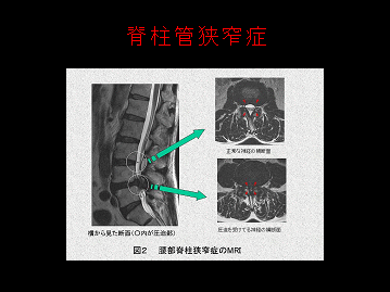 脊柱管狭窄症