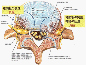 椎間板ヘルニアの図