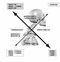 図４　上位交差症候群の概念図