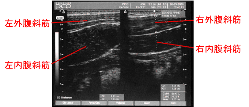 写真４　腹斜筋の超音波画像