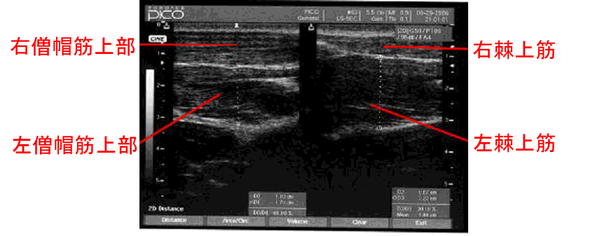 写真５　僧帽筋上部の超音波画像