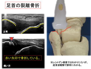 足首の裂離骨折