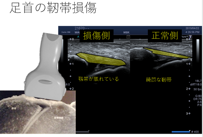 足首の靱帯損傷