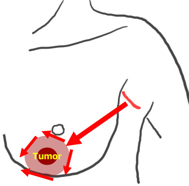 The tumor anywhere in the breast can be removed from the axillary small skin incision.
