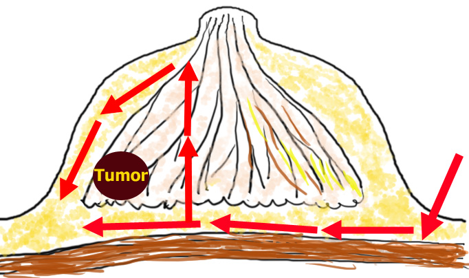 We approach from the axillary incision through the retromammary route to remove the tumor.