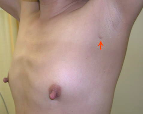 Sentinel node biopsy can be performed only by this 1 cm skin incision.