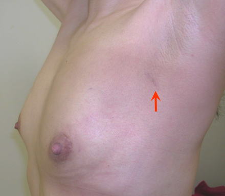 Sentinel node biopsy can be performed only by this 1 cm skin incision.