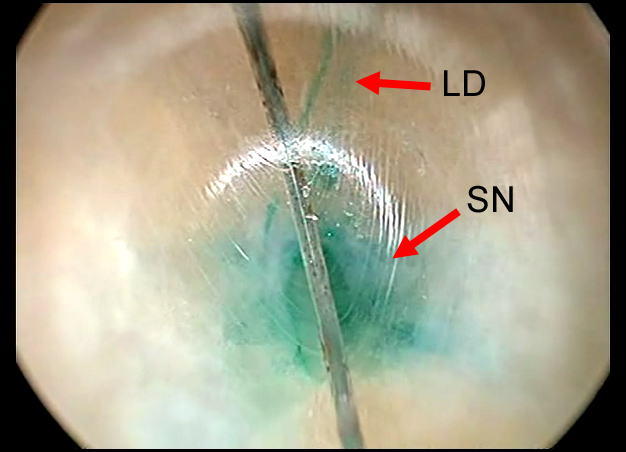 Lymph ducts and sentinel nodes are observed to be stained green. SN: sentinel node, LD: lymph duct