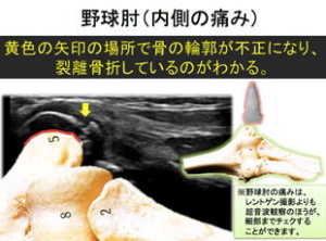 野球肘(内側の痛み)